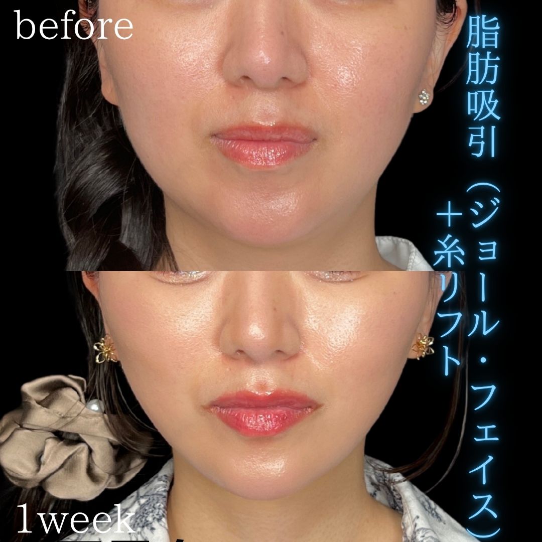 症例写真：小顔脂肪吸引＋糸リフト（術前・術後）