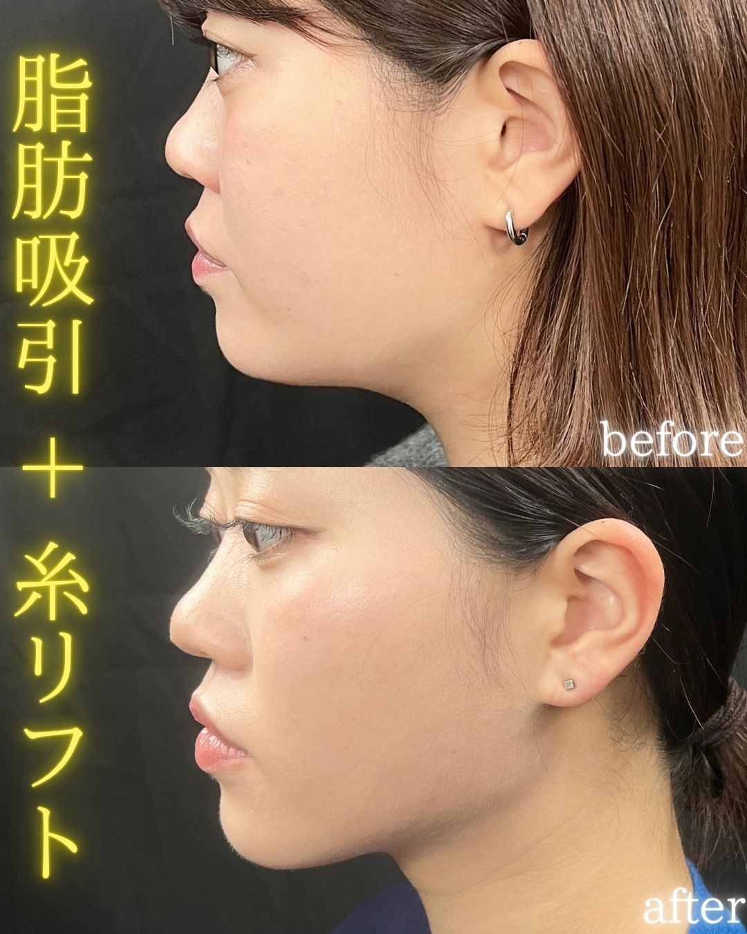 症例写真：小顔脂肪吸引＋糸リフト（術前・術後）