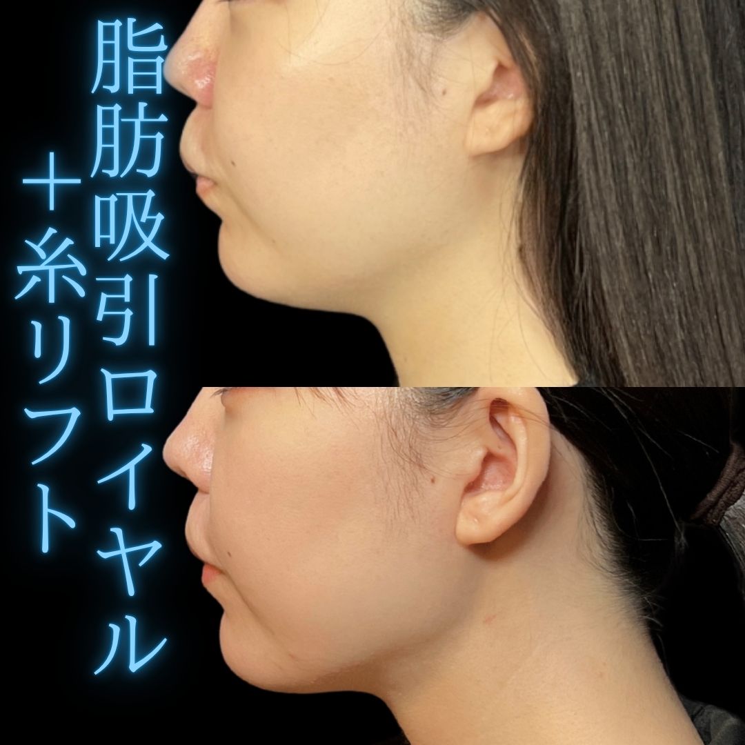 症例写真：小顔脂肪吸引＋糸リフト（術前・術後）